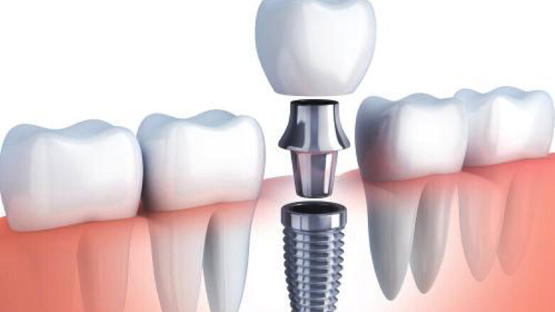 Implantes dentales en primer plano